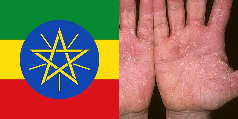 Skin Disease In Ethiopia